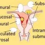 What Is Uterine Fibroid Embolization?