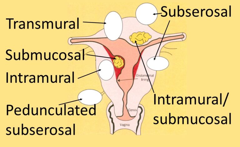 What Is Uterine Fibroid Embolization?